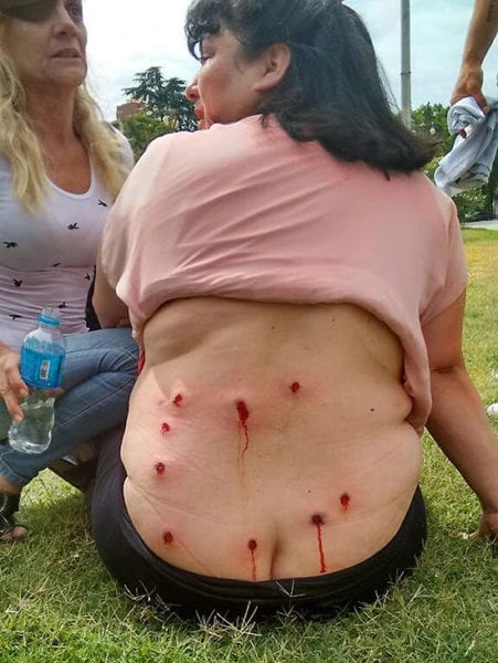 La manifestación pacífica de los trabajadores fue reprimida violentamente con balas de goma, que hacen heridas como las que recibió esta mujer en su espalda.
